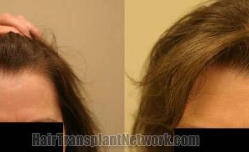 Front - View before and after hair replacement images