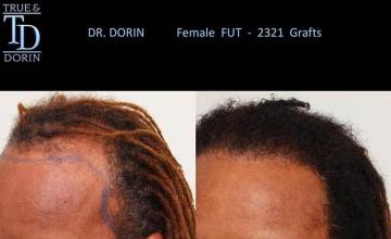 Hair transplantation surgery before and after pictures