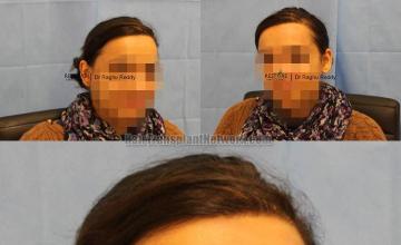 Hair transplantation surgery before and after images