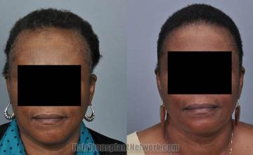 Hair restoration procedure before and after results