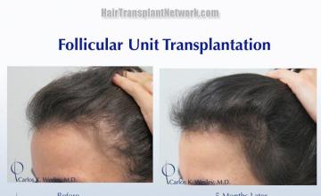 Hair restoration surgery before and after images