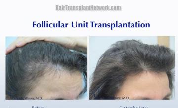 Hair restoration surgery before and after photos