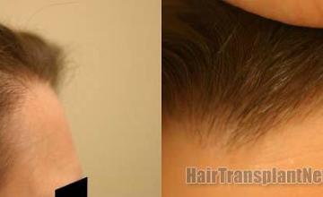 Right view - Female hair restoration procedure results