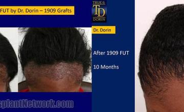 Top view - Before and after surgical hair replacement