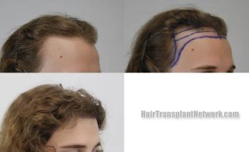 Female hair transplantation procedure before and after result