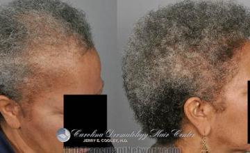 Female hair transplantation procedure before and after result