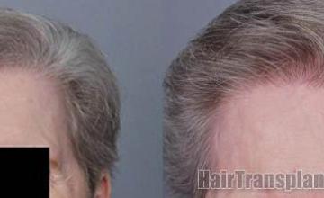 Female hair transplantation surgery before and after photos