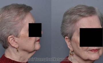 Hair restoration procedure before and after pictures