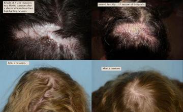 Hair transplantation surgery before and after photos