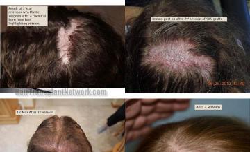 Hair restoration procedure before and after results