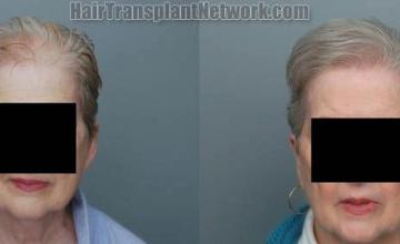 Female before and after photos