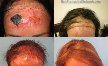 Hair restoration procedure before and after results