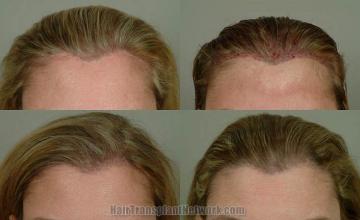 Hair transplantation surgery before and after pictures