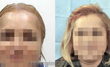 Hair restoration procedure before and after results