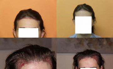 Hair transplantation surgery before and after photos