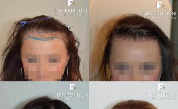 Hair transplantation surgery before and after images