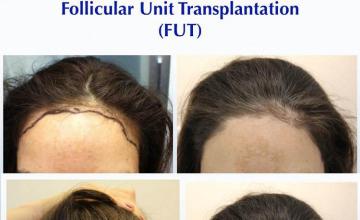 Female hair restoration procedure before and after results