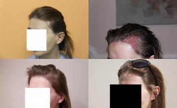 Hair transplantation surgery before and after pictures