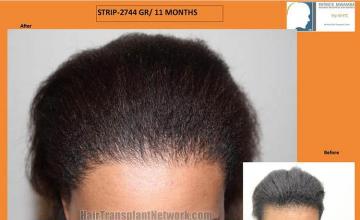 Hair transplantation surgery before and after photos