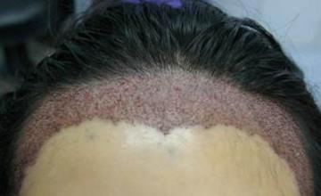 Hair transplantation surgery immediate postoperative