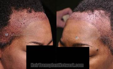 Hair restoration surgery before and after images