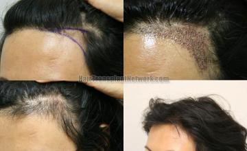 Hair restoration procedure results