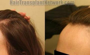 Female hair transplantation surgery before and after images