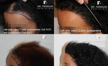 Hair transplantation surgery before and after pictures