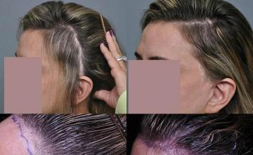 Hair transplantation surgery before and after photos