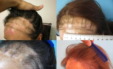 Hair transplantation surgery before and after pictures