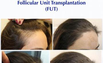 Female hair transplantation surgery before and after images