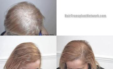 Hair transplantation surgery before and after images