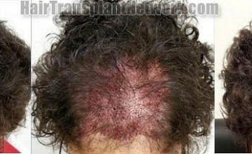 Female hair transplant before and after pictures