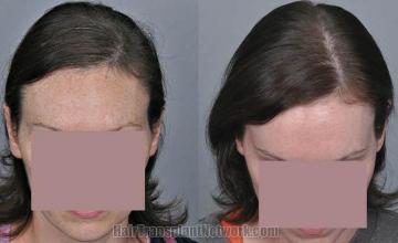 Hair transplantation surgery before and after pictures