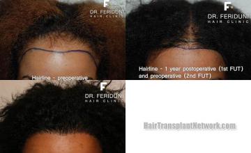 Hair restoration procedure before and after results