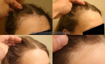 Hair restoration procedure before and after results