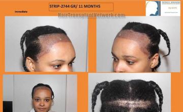 Hair restoration surgery before and after photos