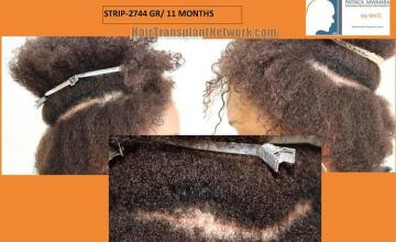 Hair restoration procedure before and after pictures