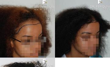 Hair restoration surgery before and after photos