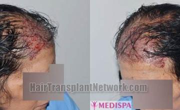 Female hair transplantation immediate postoperative photos