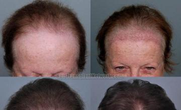 Hair restoration procedure before and after results