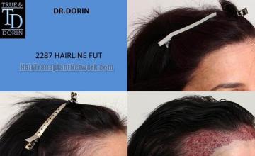 Hair transplantation surgery before and after pictures