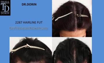 Hair transplantation surgery before and after images