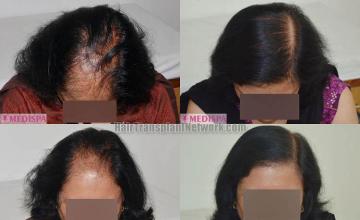 Female hair transplantation procedure before and after photos