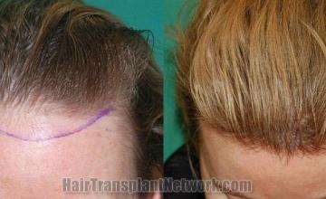 Hair restoration procedure before and after results