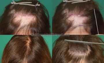 Hair transplantation surgery before and after photos