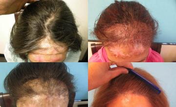 Hair transplantation surgery before and after photos