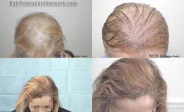 Hair transplantation surgery before and after photos