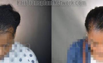 Female hair transplantation surgery before and after images