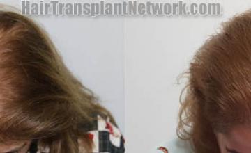 Female hair transplantation surgery before and after images